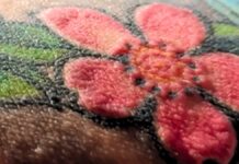 Une réaction allergique grave à l’encre de tatouage rouge entraîne des années de déclin de la santé