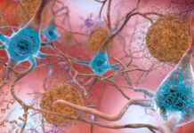 Résilience de la maladie d’Alzheimer : pourquoi certains cerveaux résistent au déclin malgré les dommages