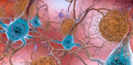 Стійкість до хвороби Альцгеймера: чому деякі мозки протистоять занепаду, незважаючи на пошкодження