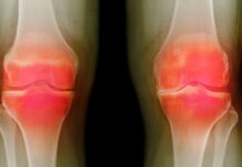 Breakthrough Research: Federal Agency Reports Progress Toward Osteoarthritis Cures