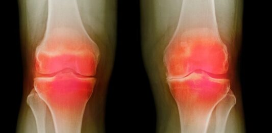 Прорив у дослідженнях: федеральне агентство повідомляє про прогрес у пошуку методів лікування остеоартриту