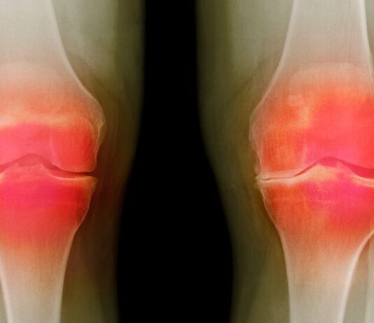 Прорив у дослідженнях: федеральне агентство повідомляє про прогрес у пошуку методів лікування остеоартриту