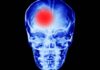 Beyond the “Normal” Range: Why Both Very Low and Very High Heart Rates May Increase Stroke Risk